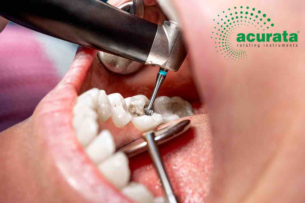 Excavation_dentinaire_A